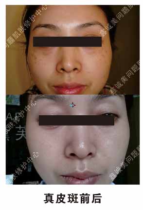 祛斑之后也不能掉以輕心，成都神奇魔斑告訴您有這些注意事項(xiàng)