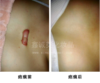 祛斑之后也不能掉以輕心，成都神奇魔斑告訴您有這些注意事項(xiàng)